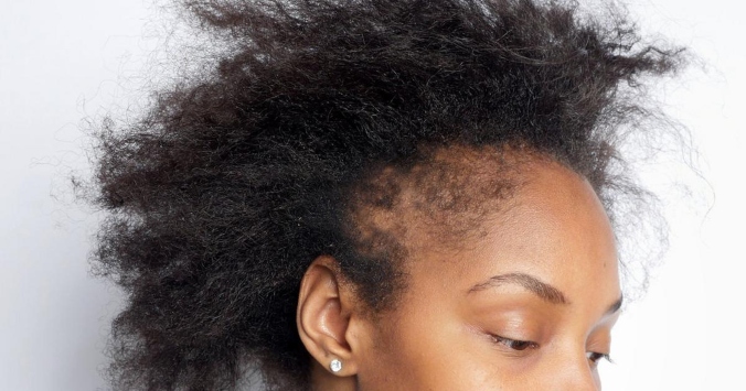 Hidden Culprits: 5 Common Ingredients In Hair Products That Cause Hair Fall